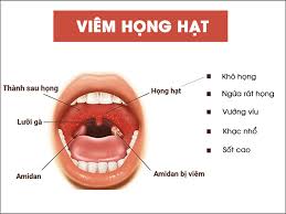 Cách sử dụng thuốc trong viêm họng amidan cấp đúng chuẩn bác sĩ