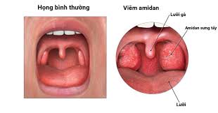 5 lưu ý quan trọng khi điều trị viêm họng amidan cấp theo đơn bác sĩ