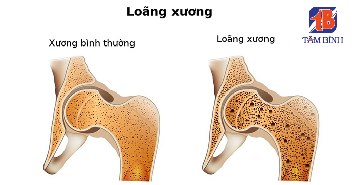 Loãng xương ở người cao tuổi – Hiểm họa thầm lặng của tuổi già