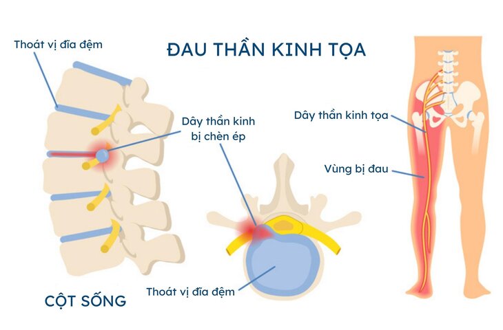 Đau dây thần kinh tọa – Nguyên nhân, triệu chứng và hướng điều trị hiệu quả