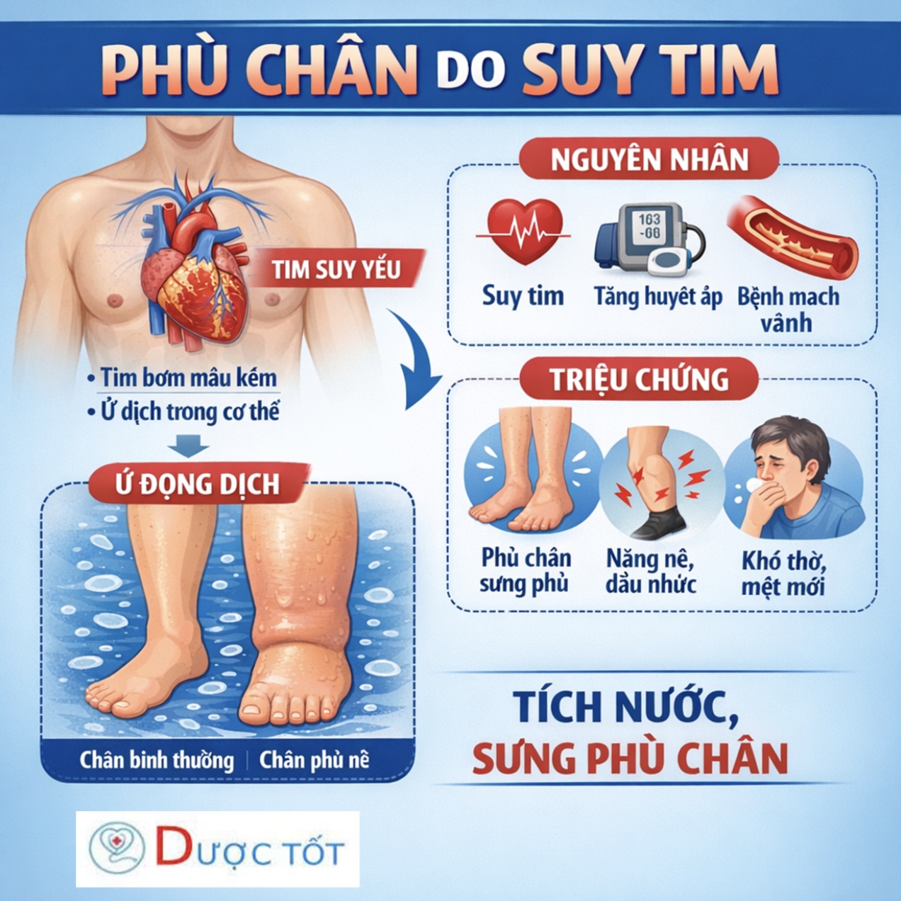 PHÙ CHÂN DO SUY TIM – XỬ LÝ THẾ NÀO?