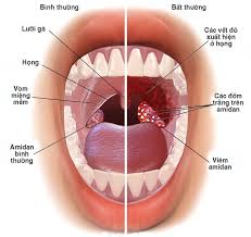 Mua thuốc viêm họng amidan cấp ở đâu an toàn, đúng đơn bác sĩ?
