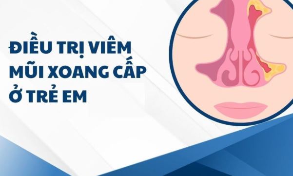Bệnh viêm mũi xoang cấp ở trẻ em: nguyên nhân