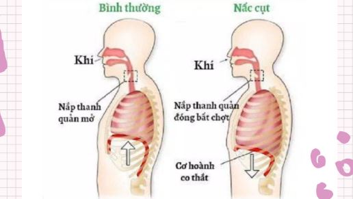 Liều thuốc nấc cụt