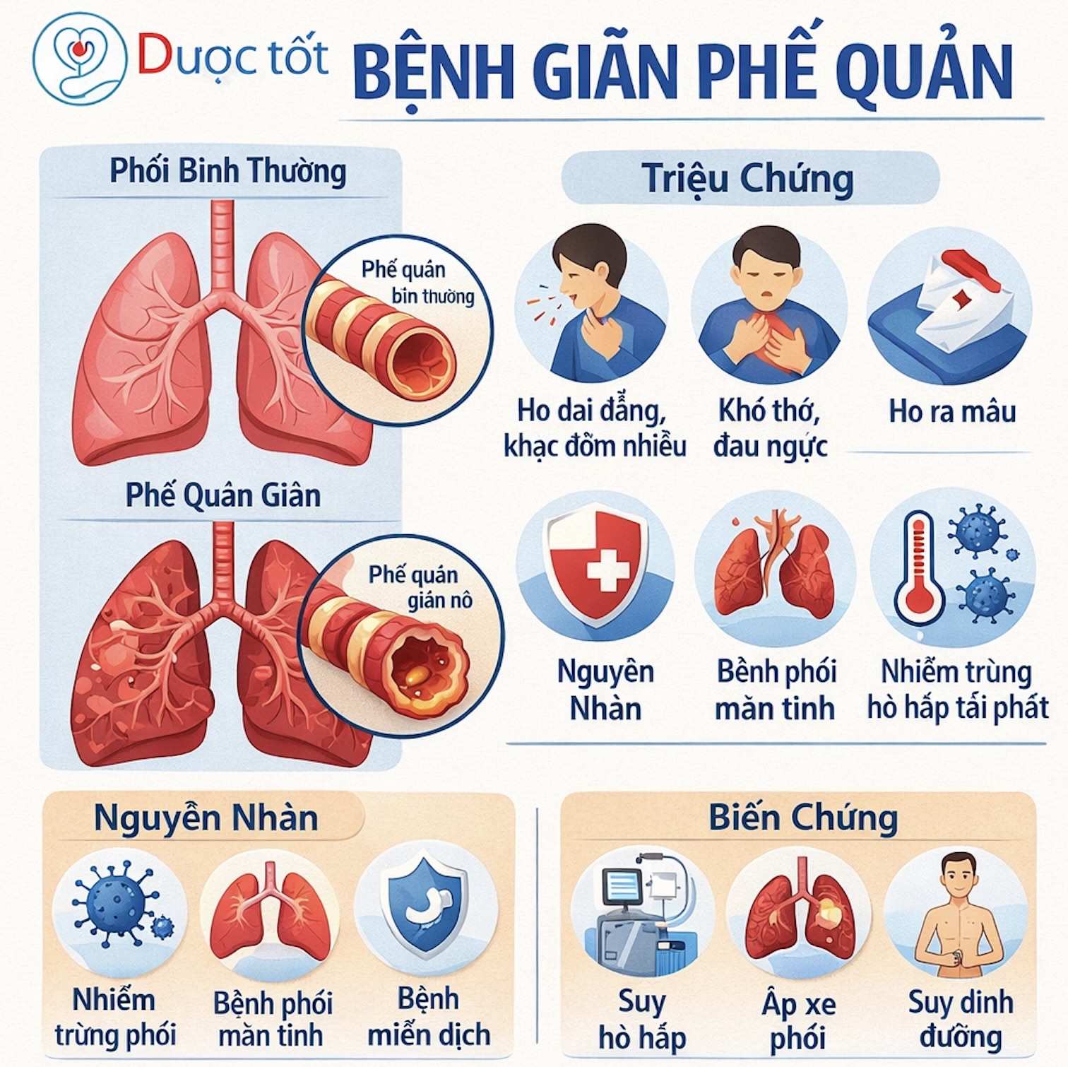Điều trị bệnh Giãn phế quản